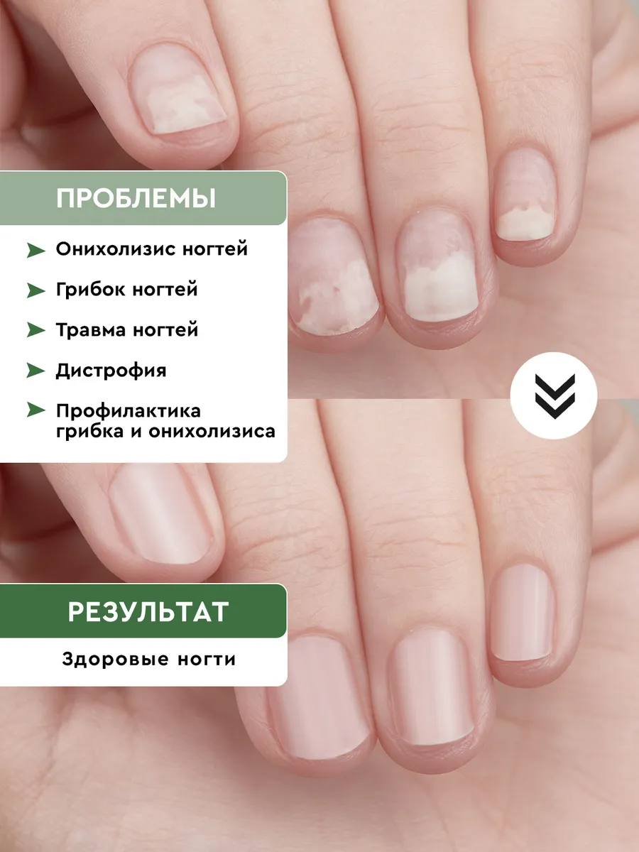 Inki бальзам. Inki бальзам стоп онихолизис. Инки средство для ногтей. Inki бальзам для ногтей регенерирующий стоп онихолизис, 10мл. Инки бальзам стоп онихолизис отзывы