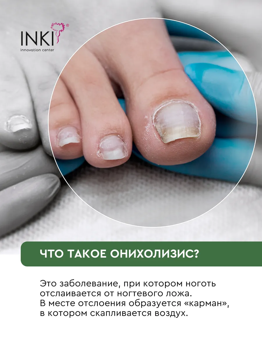 Inki бальзам. Inki бальзам стоп онихолизис. Инки средство для ногтей. Масло для ногтей стоп онихолизис. Инки средство от онихолизиса ногтей.